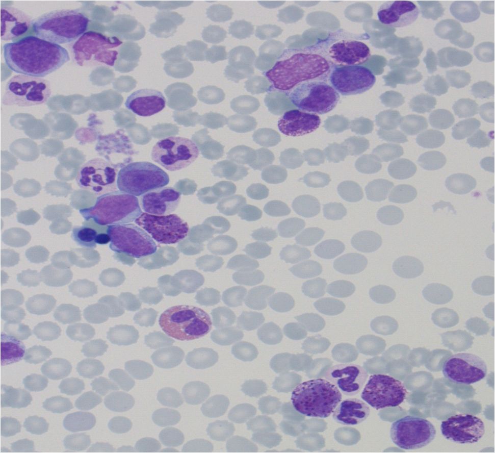Fig 4. Peripheral blood smear at diagnosis